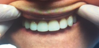 Close-up dental photo showing a restored smile with bright white, aligned upper veneers