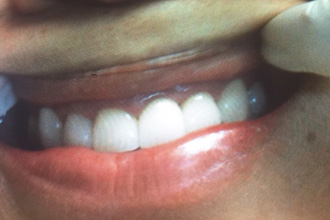 Close-up photo of a patient smiling with bright, restored, and straight white upper teeth