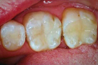 Occlusal view of lower molars restored with natural-looking tooth-colored composite resin fillings
