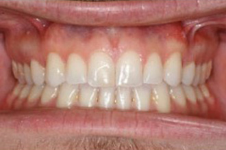 Front view of teeth after orthodontic or cosmetic treatment showing closed gaps and aligned smile