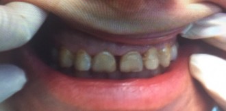 Close-up dental photo showing discolored and worn front upper teeth before cosmetic restoration