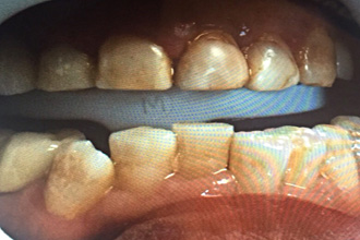 Clinical close-up showing severely stained, misaligned, and damaged teeth before treatment