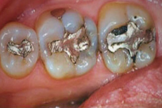 Occlusal view of lower molars showing old dark amalgam silver fillings