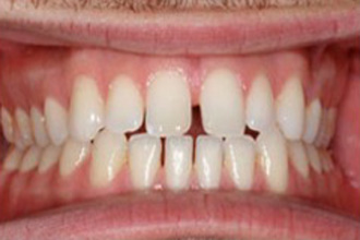 Front view of teeth showing gaps (diastema) between upper and lower front teeth